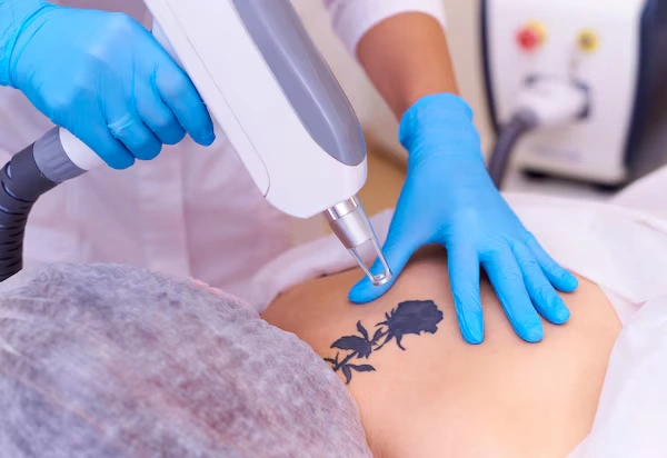 Laser Tattoo Removal